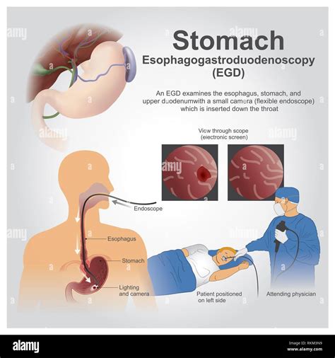 Esophagogastroduodenoscopy Anatomy