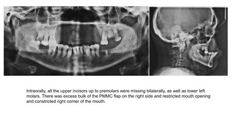 Prosthodontic Rehabilitation Of Maxillary Defect In A Patient Ppt