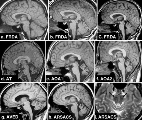 Friedreich Ataxia Mri