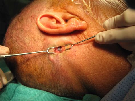 Lymph Node Neck Surgery