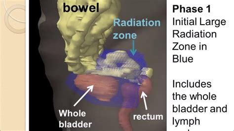 Radiation Therapy For Bladder Cancer Youtube