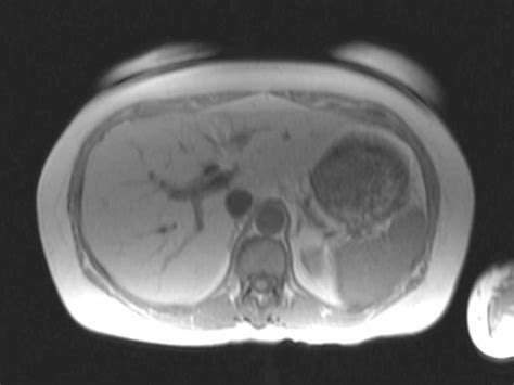 Hepatic Steatosis Body Mr Case Studies Ctisus Ct Scanning