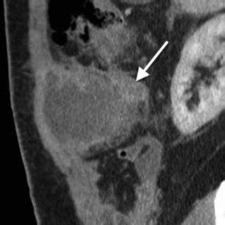 An Axial Ct With Contrast Showing The Ruq Appendiceal Abscess