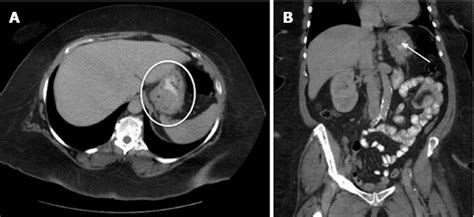 Modern Treatment Of Gastric Gastrointestinal Stromal Tumors