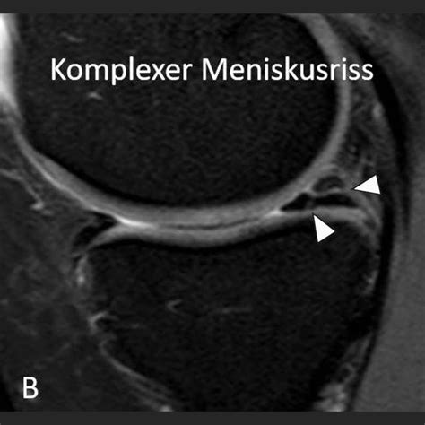 Mri Scan Of The Knee And Meniscus Procedure And Pictures