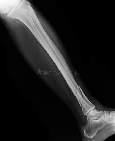 Radiografa A Imagem De Pacientes Da Fratura Do Pé Foto De Stock Imagem De Fratura Tecido