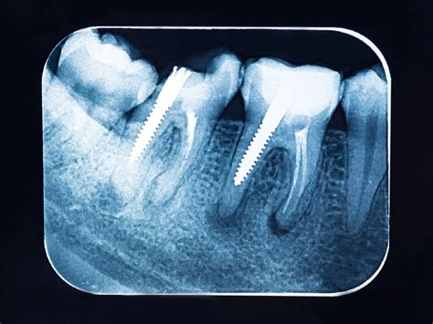 Scellement Des Sillons à Visée Prophylactique Dentiste Paris 19