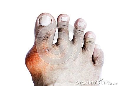 Gout Of The Big Toe Stock Photography | CartoonDealer.com #42520046