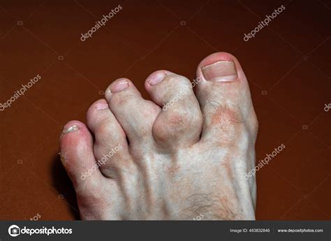Hot Feet Syndrome