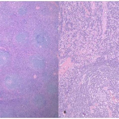 A Parapharyngeal Lymph Node Hande 20× B Parapharyngeal Lymph Node