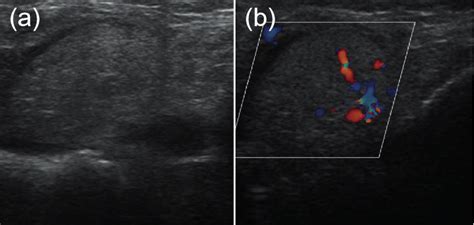 A In Lupus Panniculitis A Slightly Hyperechoic Ovoid Download