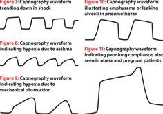 capnography cheat sheet