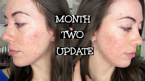 Month 2 Skin Update Isotretinoin Carson Ensley Youtube