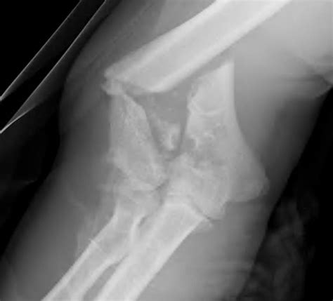 Distal Humerus Fractures The Bone School