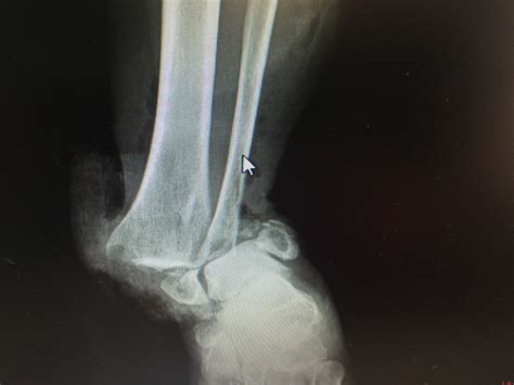 UHN Blog Emergency Coping With A Broken Ankle Overseas University