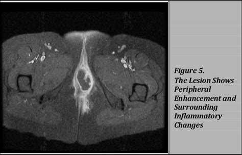 Bartholin Gland Cyst Mri