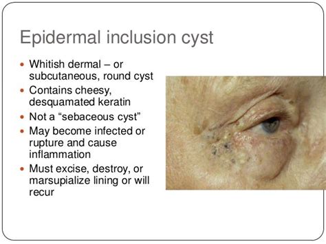 [DIAGRAM] Diagram Of Epidermal Inclusion Cyst - MYDIAGRAM.ONLINE