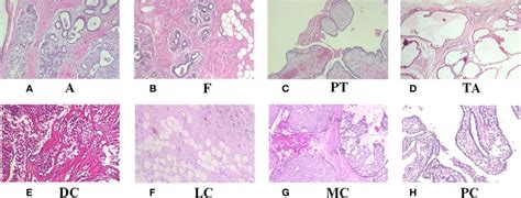 H E Stained Breast Cancer Histopathological Images Of Tumor Types