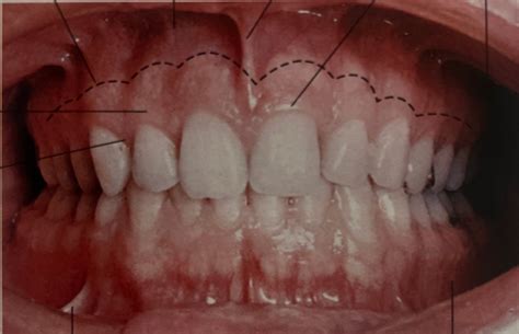 Gingivae Diagram Quizlet