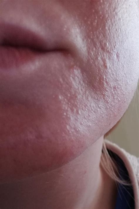 Skin Concerns Very Tiny Bumps On Face After Retinol Use Purging Or Allergy R