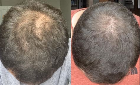 Finasteride Minoxidil Biotin 3 Month Progress R Hairloss