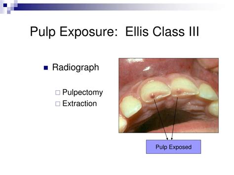 Ellis Class 3 Fracture Treatment Images – FRACTURE