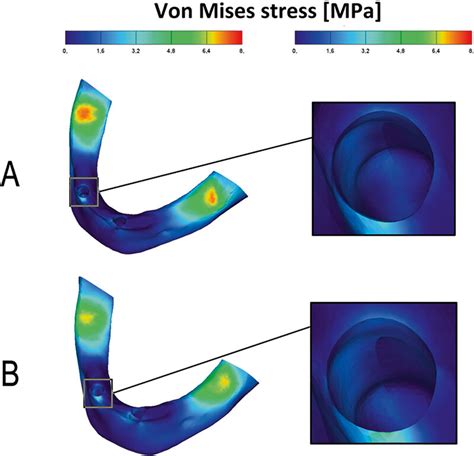 The Von Mises Stress Distribution In The Cortical Bone Ball Download Scientific Diagram