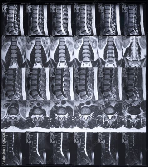 Foto De Magnetic Resonance Tomography MRT Of The Lumbar Spine Hernia