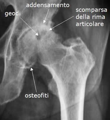 Fratture Testa Femorale E Collo Del Femore Ortopedia Ospedale Srl