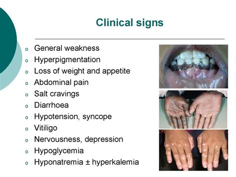 Hypocortisolism Addison S Disease Online Presentation