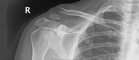 Distal Clavicle Fracture