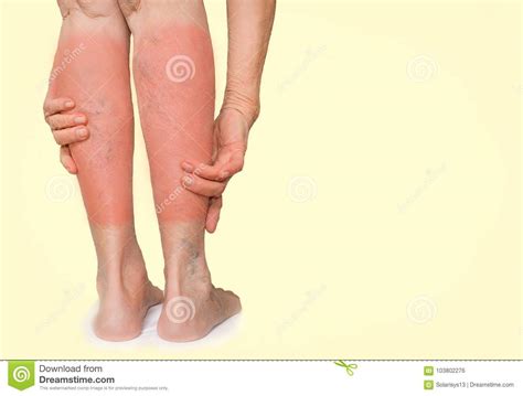 The Female Legs With Veins Varicose Spider Stock Photo Image Of