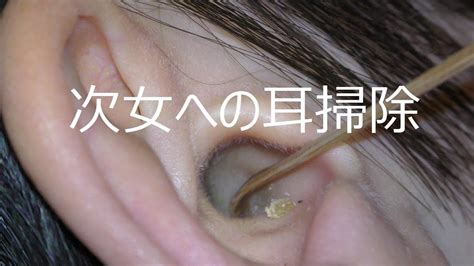 【耳掃除】次女の耳 匠の技を試す Earwax Youtube