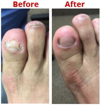 does toenail fungus turn black - Toenail Fungus Treatment | Toenail ...