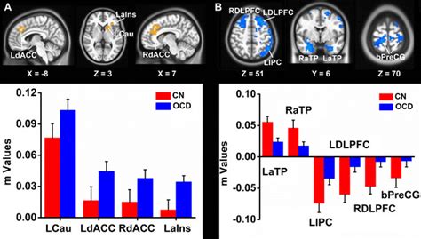 Differential Connectivity Of Nacc Networks Between Ocd Patients And Cn