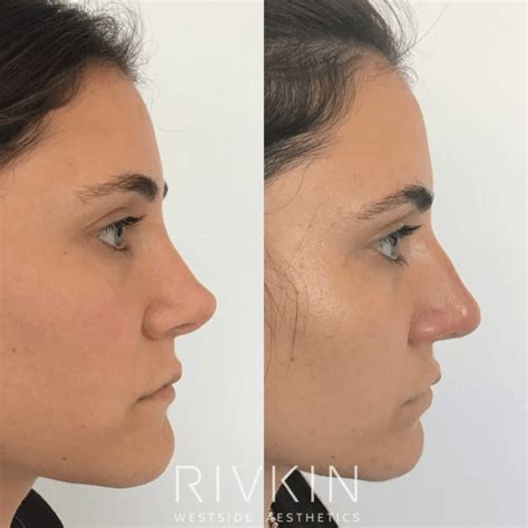 Non Surgical Rhinoplasty Los Angeles Non Invasive Cosmetic Surgery