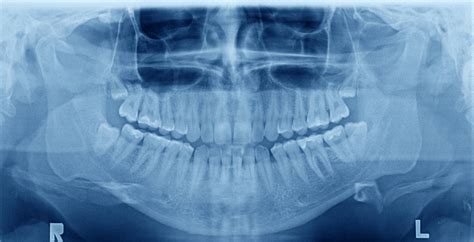 Types of Dental X-Rays: A Guide to Understanding Different Procedures ...