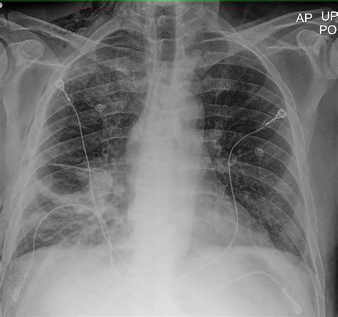 Staph Infection In The Lungs