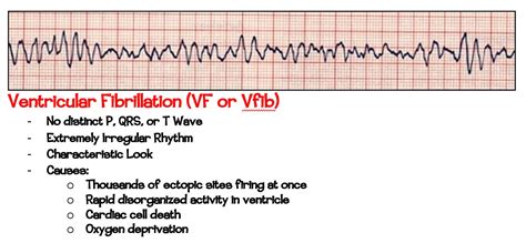 Ekg And Dysrhythmia Interpretation Etsy