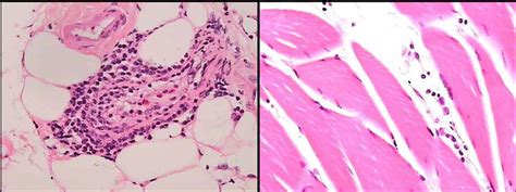 Muscle biopsy – perimysium and perivascular infiltration of muscle with ...