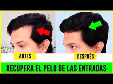 Como Hacer Crecer El Cabello De Las Entradas Recuperar El Cabello