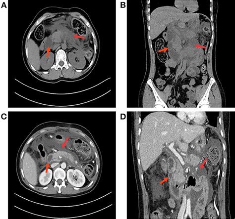 Frontiers Wernickes Encephalopathy After Acute Pancreatitis With Upper Gastrointestinal