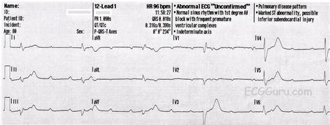 High-Grade AV Block | ECG Guru - Instructor Resources