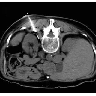 Percutaneous Computed Tomography Guided Core Needle Biopsy Of A