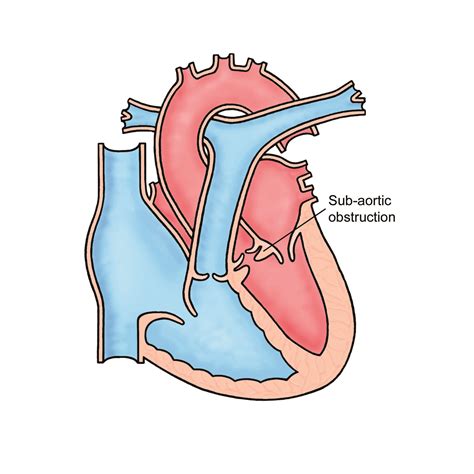 Subaortic Stenosis Leeds Teaching Hospitals Nhs Trust