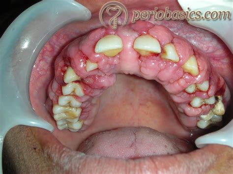 Gingival Enlargement Clinical Periodontology