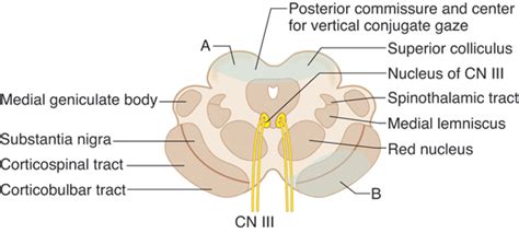 midbrain A: weber syndrome | Spinothalamic tract, Test prep, Neuro