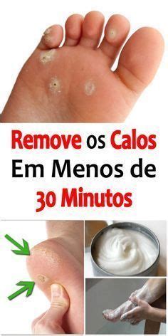 Calos Nas Mãos E Nos Pés Saiba Como Tirar Hoje