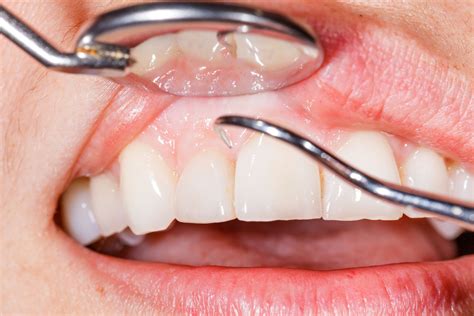 Periodontal Disease Causes Symptoms Treatments