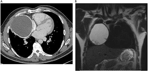 Mediastinal Cystic Teratoma Masquerading As A Hydatid Cyst Bmj Case